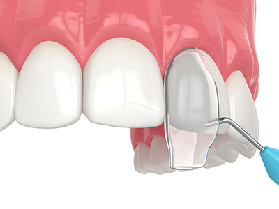 The image shows a close-up view of a dental implant being inserted into a tooth socket using a specialized tool, with the surrounding teeth and gum tissue visible.