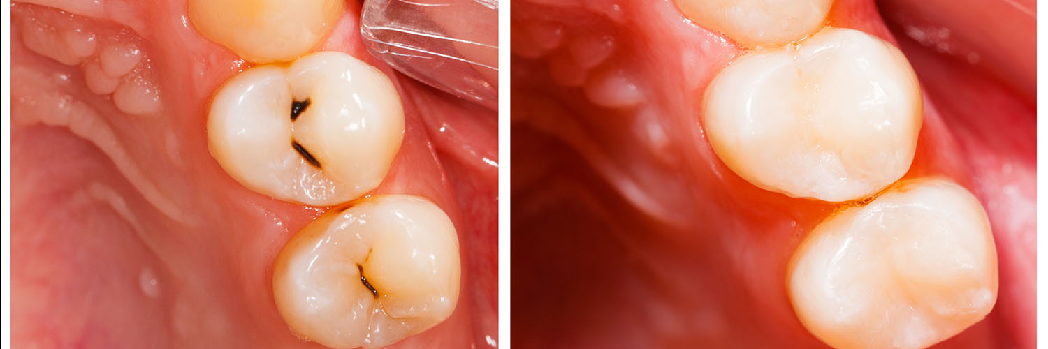 The image shows a close-up view of a human mouth with teeth, a tongue, and the interior of the oral cavity, including gums and saliva.